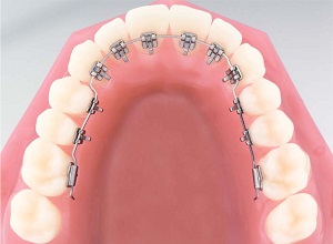 Görünmeyen Ortodonti