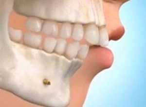 Çene Eklemi Tedavisi